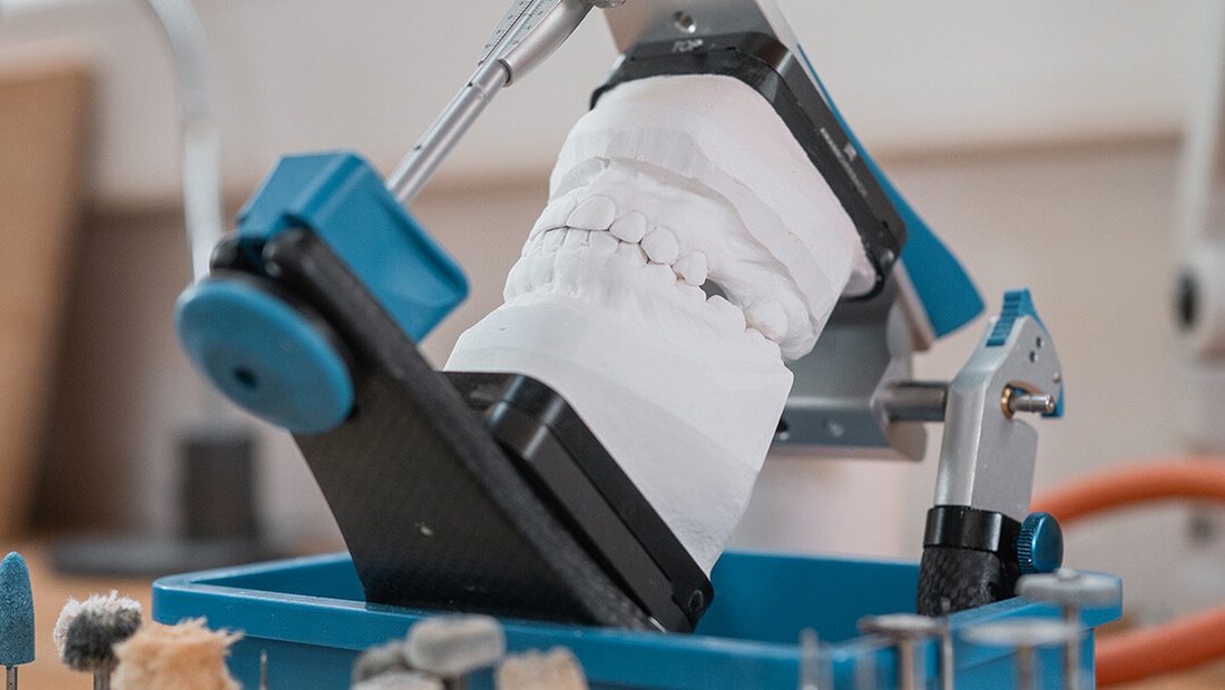 Pianificazione implantare su modello nel laboratorio SD
